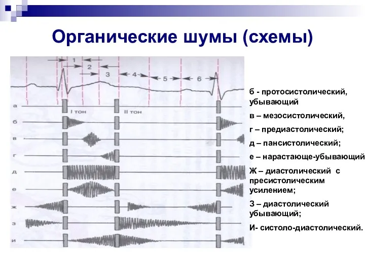 Органические шумы (схемы) б - протосистолический, убывающий в – мезосистолический,