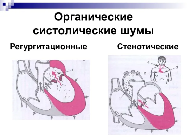 Органические систолические шумы Регургитационные Стенотические