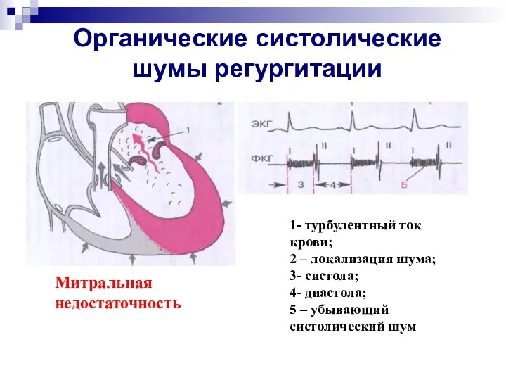 Органические систолические шумы регургитации Митральная недостаточность 1- турбулентный ток крови;