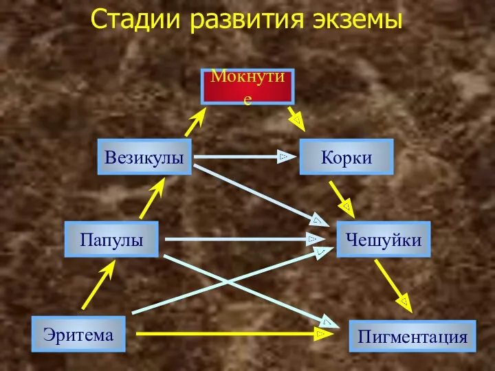 Стадии развития экземы Эритема Папулы Везикулы Чешуйки Корки Мокнутие Пигментация