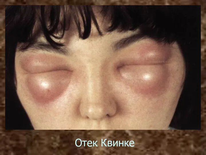 Отек Квинке