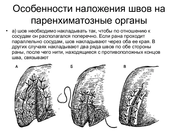 Особенности наложения швов на паренхиматозные органы а) шов необходимо накладывать