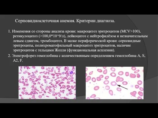Серповидноклеточная анемия. Критерии диагноза. 1. Изменения со стороны анализа крови: макроцитоз эритроцитов (MCV>100),