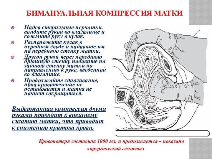 БИМАНУАЛЬНАЯ КОМПРЕССИЯ МАТКИ Надев стерильные перчатки, войдите рукой во влагалище