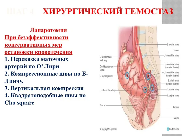 ШАГ 4 ХИРУРГИЧЕСКИЙ ГЕМОСТАЗ Лапаротомия При безэффективности консервативных мер остановки