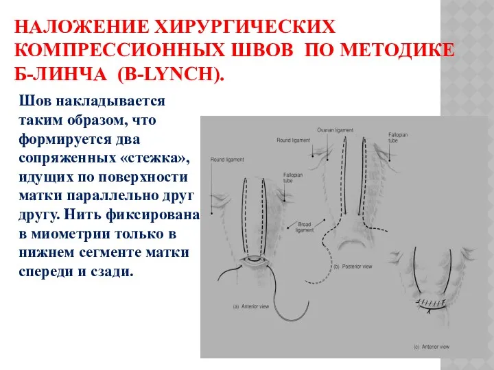 НАЛОЖЕНИЕ ХИРУРГИЧЕСКИХ КОМПРЕССИОННЫХ ШВОВ ПО МЕТОДИКЕ Б-ЛИНЧА (B-LYNCH). Шов накладывается