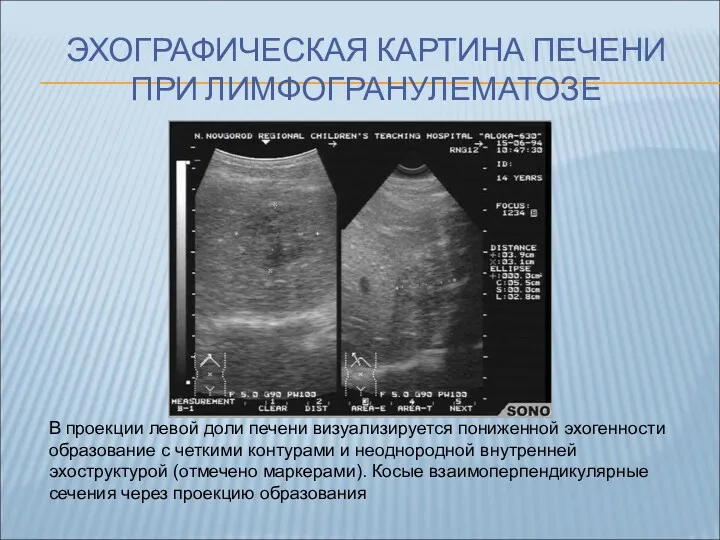 ЭХОГРАФИЧЕСКАЯ КАРТИНА ПЕЧЕНИ ПРИ ЛИМФОГРАНУЛЕМАТОЗЕ В проекции левой доли печени