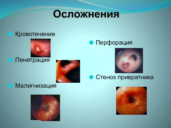 Осложнения Кровотечение Перфорация Пенетрация Стеноз привратника Малигнизация