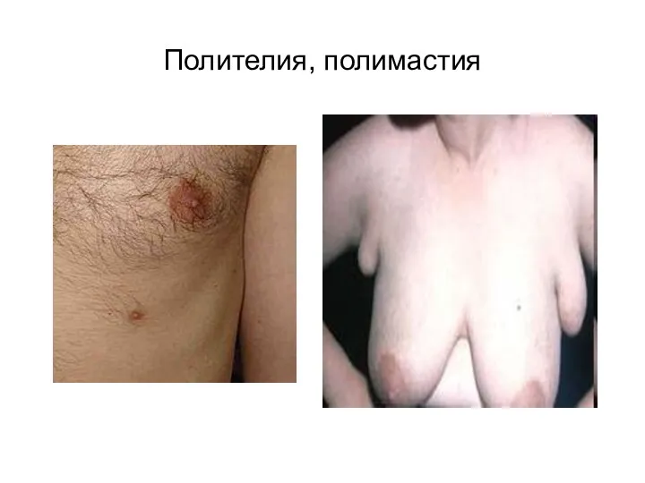 Полителия, полимастия