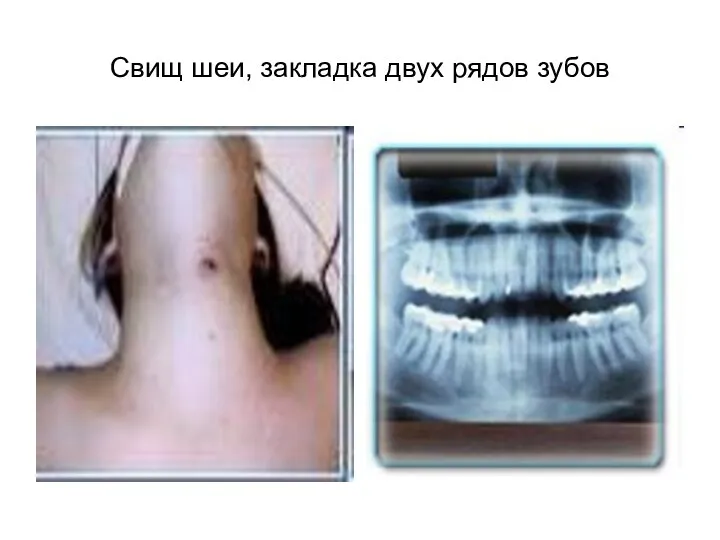 Свищ шеи, закладка двух рядов зубов