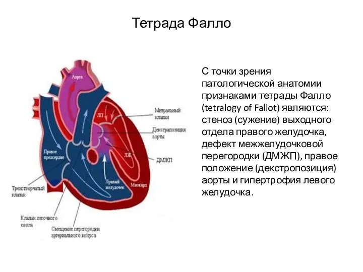 Тетрада Фалло С точки зрения патологической анатомии признаками тетрады Фалло