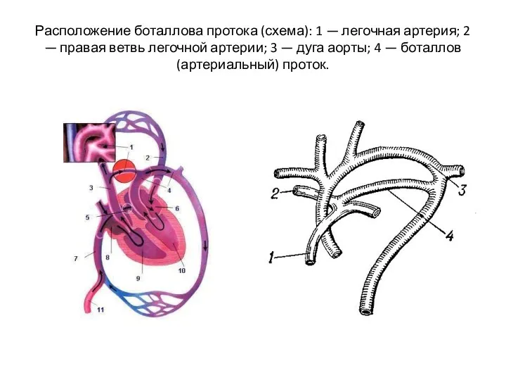 Расположение боталлова протока (схема): 1 — легочная артерия; 2 —