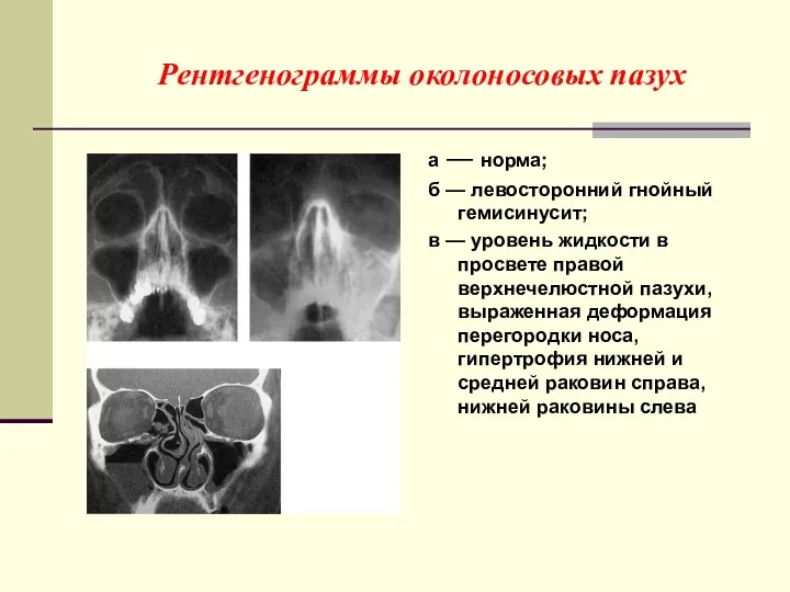 Рентгенограммы околоносовых пазух а — норма; б — левосторонний гнойный гемисинусит; в —