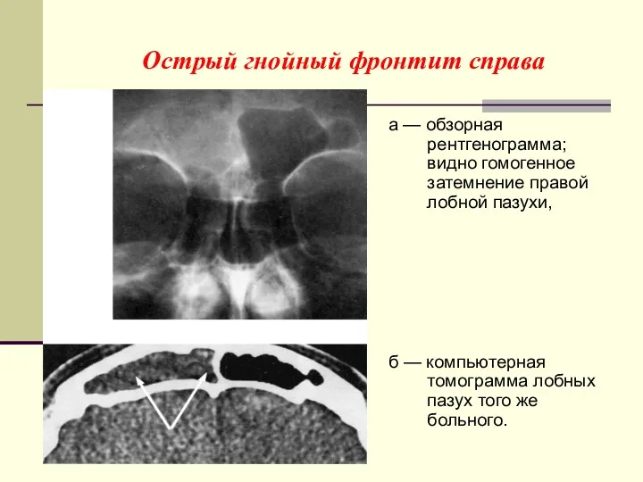 Острый гнойный фронтит справа а — обзорная рентгенограмма; видно гомогенное затемнение правой лобной