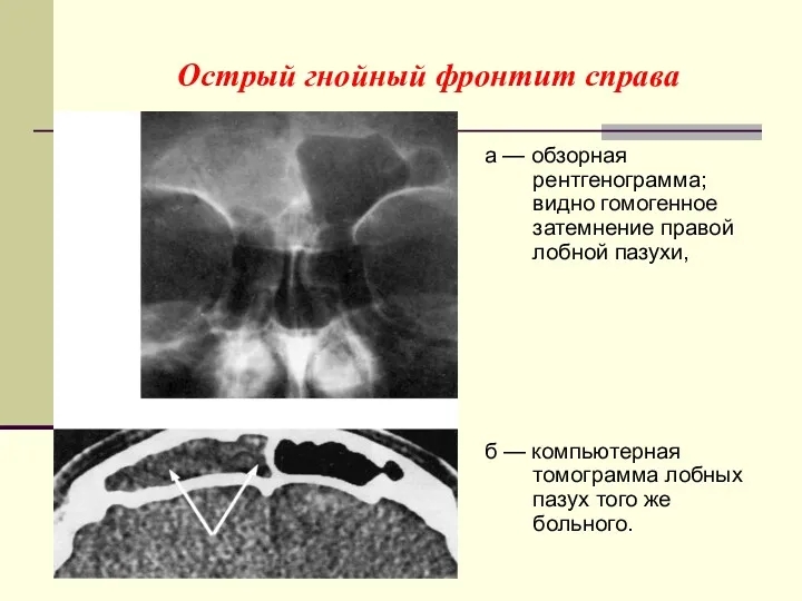 Острый гнойный фронтит справа а — обзорная рентгенограмма; видно гомогенное