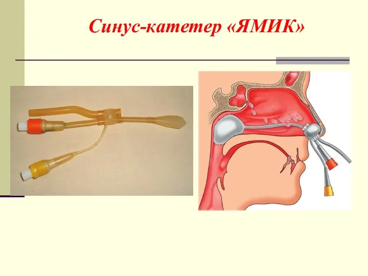 Синус-катетер «ЯМИК»