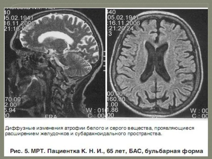 Инструментальные исследования Игольчатая ЭМГ Стимуляционная ЭМГ ТКМС МРТ Лабораторная диагностика: молекулярно-генетический анализ гена СОД1