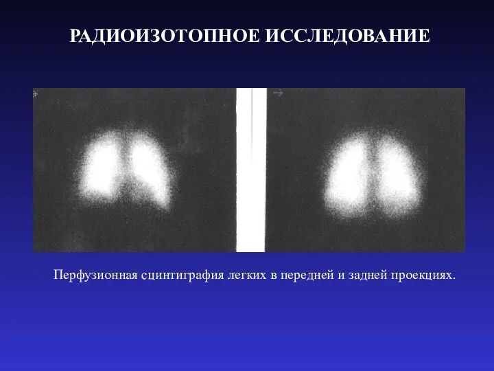 РАДИОИЗОТОПНОЕ ИССЛЕДОВАНИЕ Перфузионная сцинтиграфия легких в передней и задней проекциях.