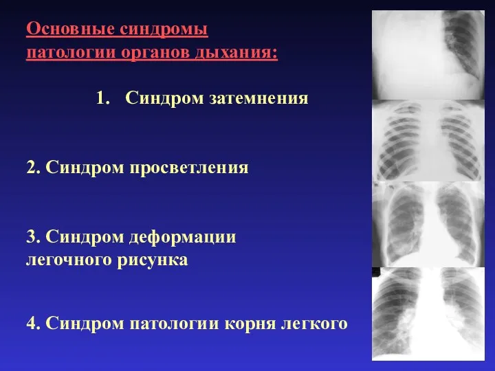 Основные синдромы патологии органов дыхания: Синдром затемнения 2. Синдром просветления