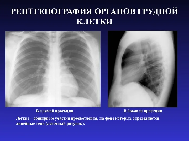 РЕНТГЕНОГРАФИЯ ОРГАНОВ ГРУДНОЙ КЛЕТКИ В прямой проекции В боковой проекции