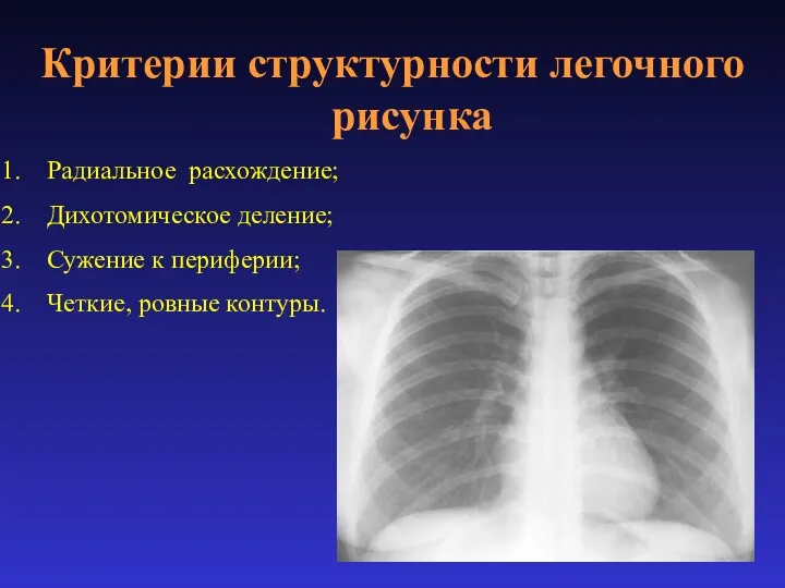 Критерии структурности легочного рисунка Радиальное расхождение; Дихотомическое деление; Сужение к периферии; Четкие, ровные контуры.