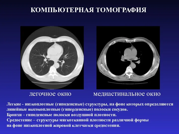 КОМПЬЮТЕРНАЯ ТОМОГРАФИЯ легочное окно медиастинальное окно Легкие - низкоплотные (гиподенсные)