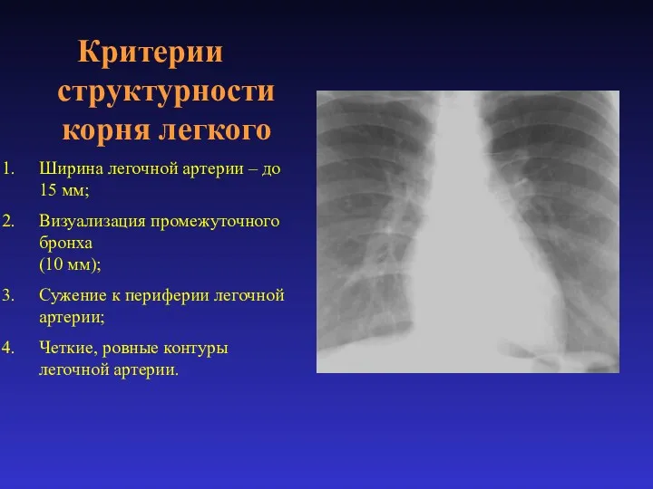 Критерии структурности корня легкого Ширина легочной артерии – до 15