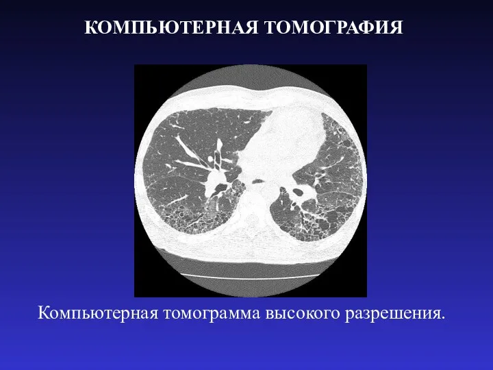 КОМПЬЮТЕРНАЯ ТОМОГРАФИЯ Компьютерная томограмма высокого разрешения.