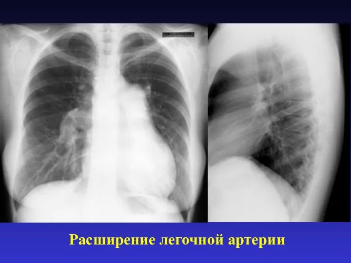 Расширение легочной артерии