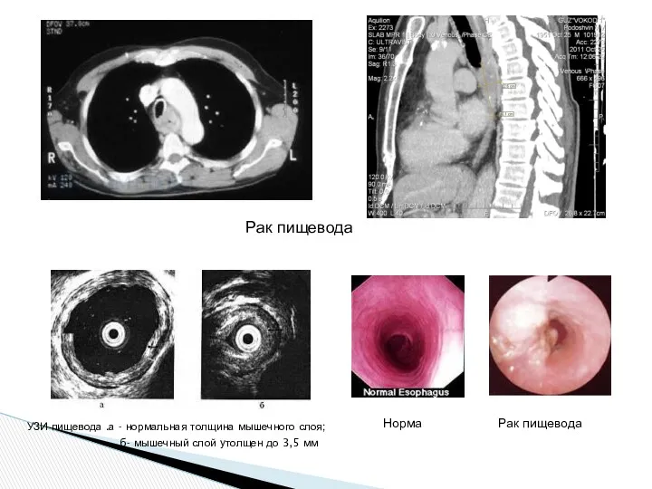 УЗИ пищевода .а - нормальная толщина мышечного слоя; б- мышечный