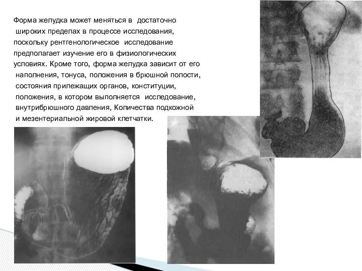 Форма желудка может меняться в достаточно широких пределах в процессе