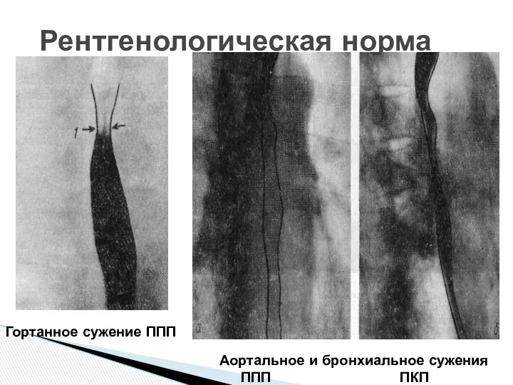 Рентгенологическая норма Гортанное сужение ППП Аортальное и бронхиальное сужения ППП ПКП