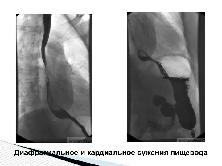 Диафрагмальное и кардиальное сужения пищевода