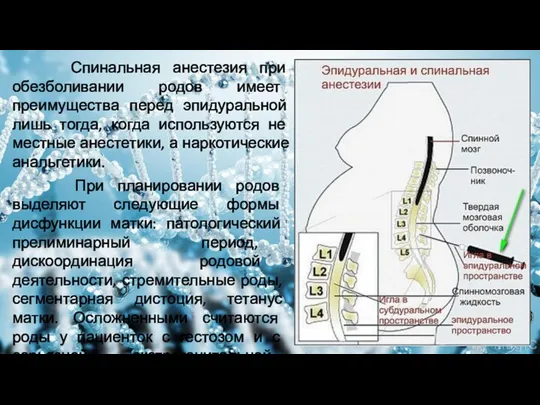 Спинальная анестезия при обезболивании родов имеет преимущества перед эпидуральной лишь