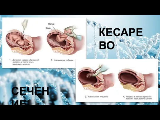 КЕСАРЕВО СЕЧЕНИЕ