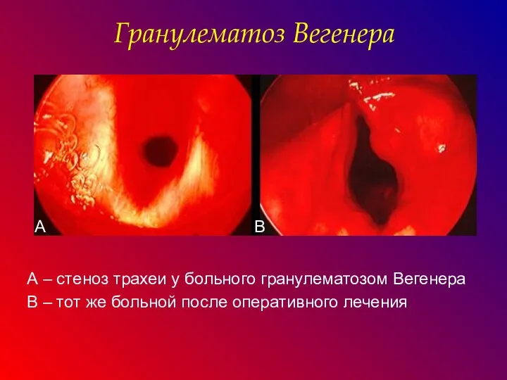 А – стеноз трахеи у больного гранулематозом Вегенера В – тот же больной