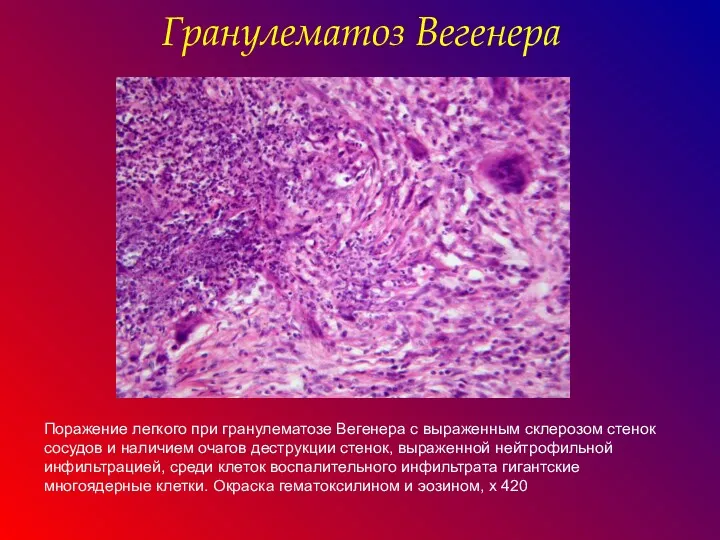 Поражение легкого при гранулематозе Вегенера с выраженным склерозом стенок сосудов и наличием очагов