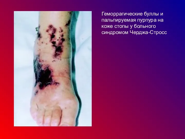 Геморрагические буллы и пальпируемая пурпура на коже стопы у больного синдромом Черджа-Стросс