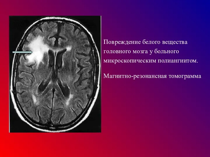 Повреждение белого вещества головного мозга у больного микроскопическим полиангиитом. Магнитно-резонансная томограмма