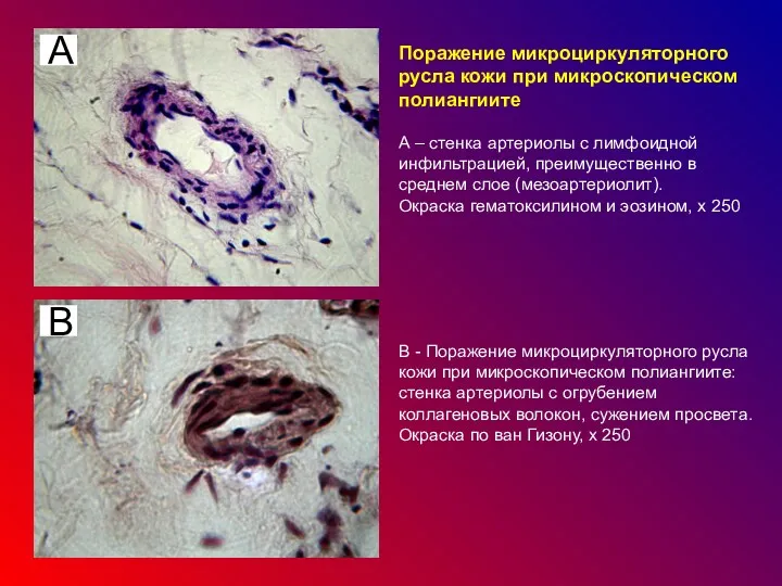 Поражение микроциркуляторного русла кожи при микроскопическом полиангиите А – стенка артериолы с лимфоидной