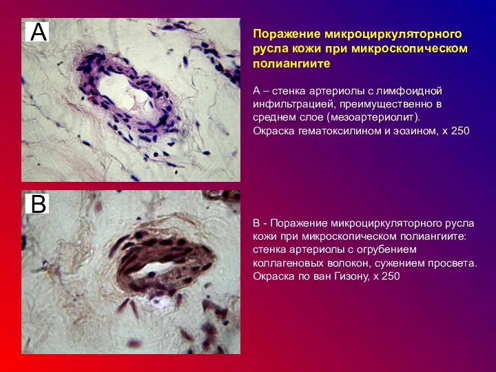 Поражение микроциркуляторного русла кожи при микроскопическом полиангиите А – стенка