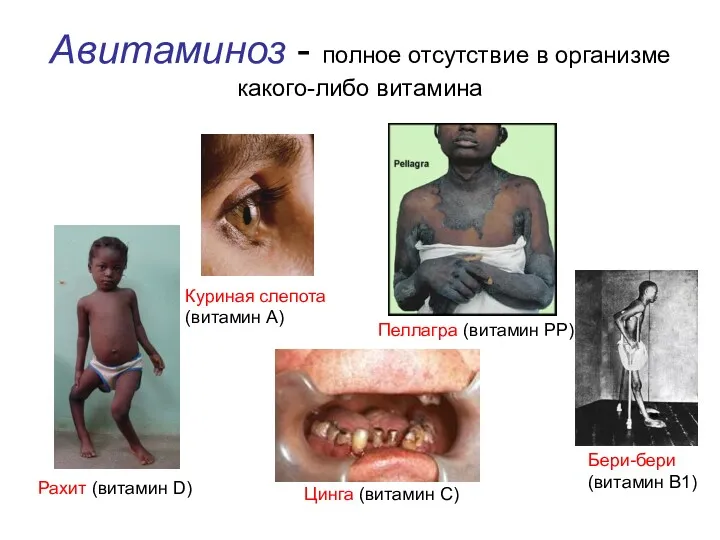 Авитаминоз - полное отсутствие в организме какого-либо витамина Рахит (витамин