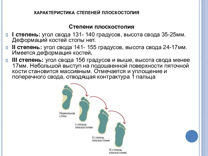 характеристика степеней плоскостопия Степени плоскостопия I степень: угол свода 131-