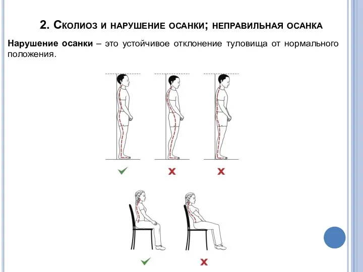 2. Сколиоз и нарушение осанки; неправильная осанка Нарушение осанки –