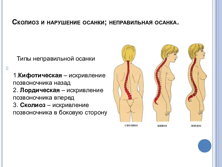 Типы неправильной осанки 1.Кифотическая – искривление позвоночника назад 2. Лордическая