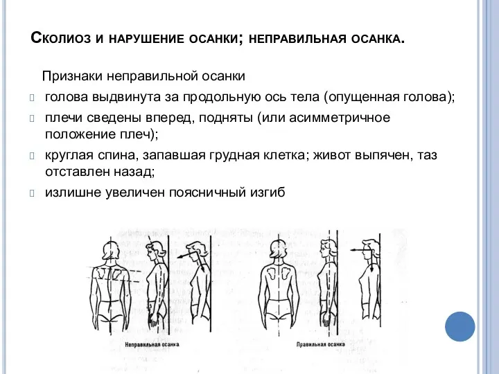 Сколиоз и нарушение осанки; неправильная осанка. Признаки неправильной осанки голова