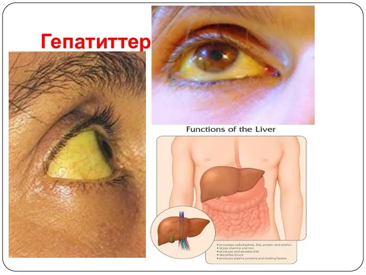 Гепатиттер