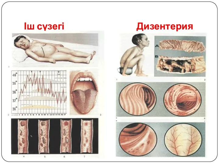 Іш сүзегі Дизентерия