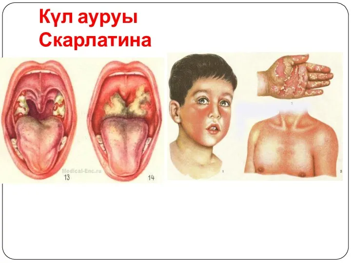 Күл ауруы Скарлатина