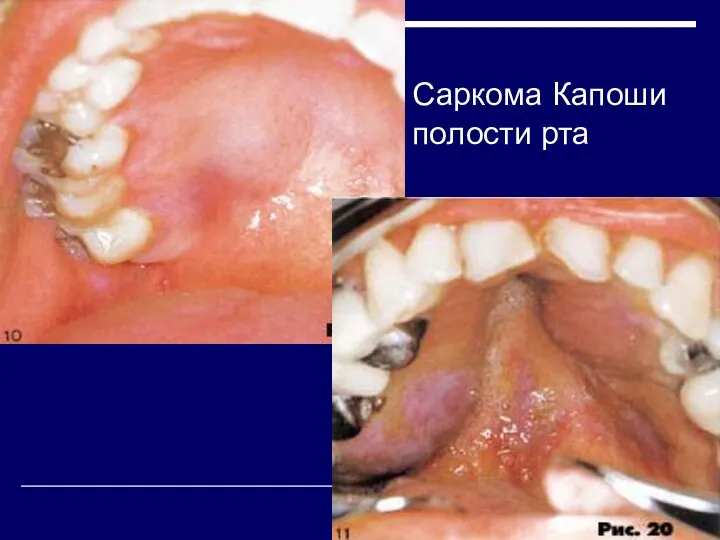 Саркома Капоши полости рта